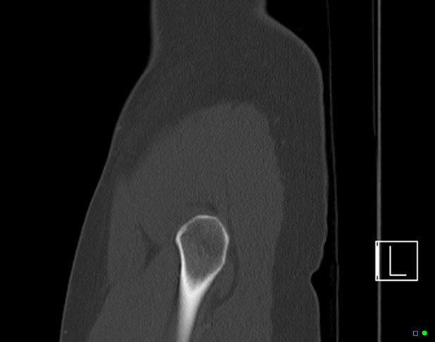 File:Bilateral acetabular fractures (Radiopaedia 79272-92308 Sagittal bone window 4).jpg