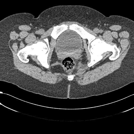 Bilateral acetabular protrusion with pincer type femoro-acetabular impingement (Radiopaedia 30134-30733 AXIAL SOFT THIN 57).jpg