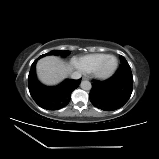 Bilateral adrenal granulocytic sarcomas (chloromas) (Radiopaedia 78375-91007 A 14).jpg