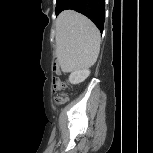 Bilateral adrenal granulocytic sarcomas (chloromas) (Radiopaedia 78375-91007 C 40).jpg