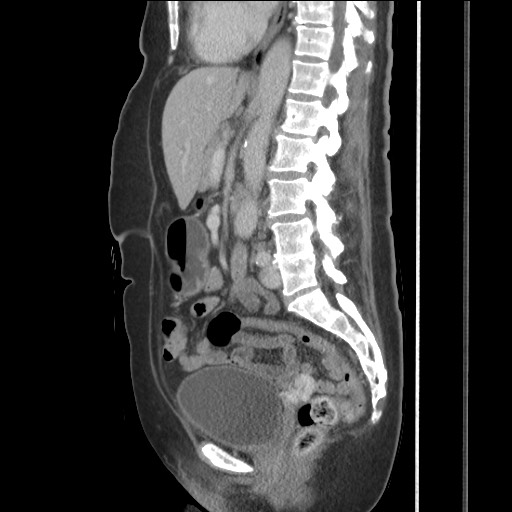 Bilateral adrenal granulocytic sarcomas (chloromas) (Radiopaedia 78375-91007 C 76).jpg