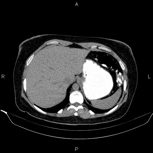 Bilateral adrenal myelolipoma (Radiopaedia 63058-71535 Axial non-contrast 26).jpg