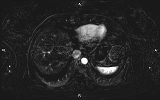 Bilateral adrenal myelolipoma (Radiopaedia 63058-71537 I 14).jpg