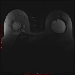 File:Bilateral breast implant rupture (Radiopaedia 24761-25027 PASTA Si 9).jpg