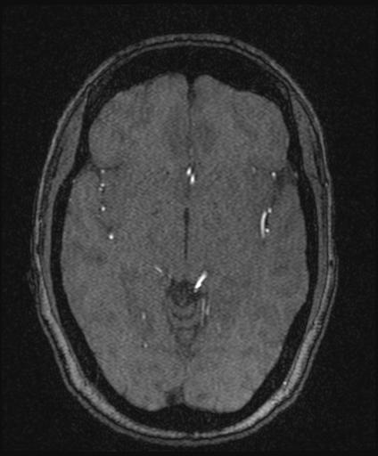 Bilateral carotid body tumors and right glomus jugulare tumor (Radiopaedia 20024-20060 Axial MRA 87).jpg
