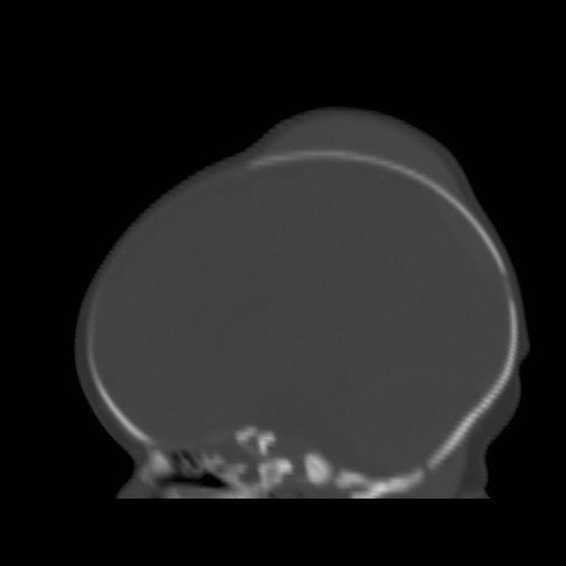 File:Bilateral cephalohematomas and subdural hematomas (Radiopaedia 26778-26929 Sagittal bone window 18).jpg