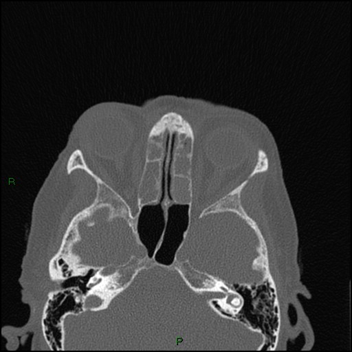 Bilateral frontal mucoceles (Radiopaedia 82352-96454 Axial bone window 143).jpg