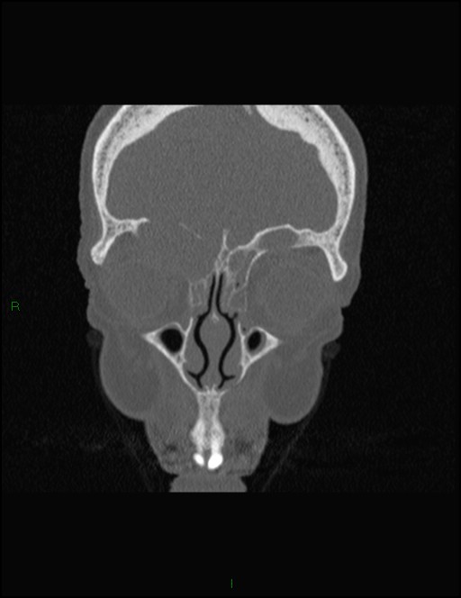 Bilateral frontal mucoceles (Radiopaedia 82352-96454 Coronal 93).jpg