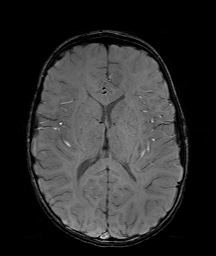 Bilateral mesial temporal polymicrogyria (Radiopaedia 76456-88181 Axial SWI 38).jpg