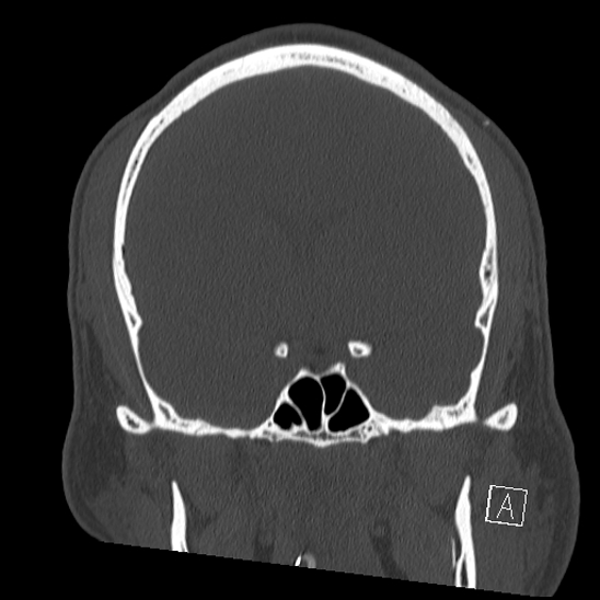 Bilateral occipital condyle fracture (type 2) (Radiopaedia 87675-104089 Coronal bone window 50).jpg