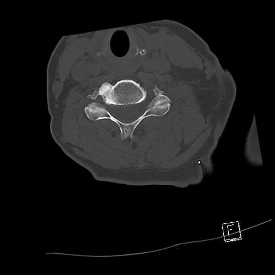 Bilateral occipital condyle fractures (type 3) (Radiopaedia 87672-104086 Axial bone window 50).jpg