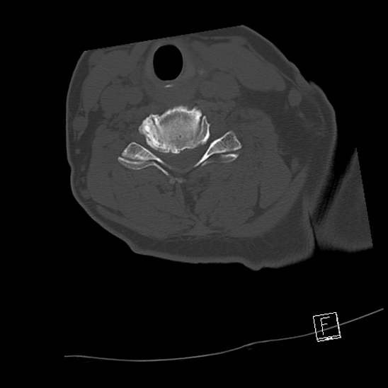 Bilateral occipital condyle fractures (type 3) (Radiopaedia 87672-104086 Axial bone window 52).jpg