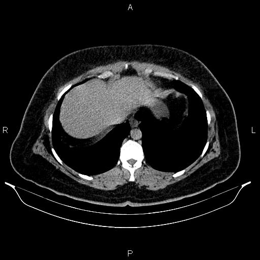 Bilateral ovarian dermoid cysts (Radiopaedia 85785-101603 Axial C+ delayed 2).jpg