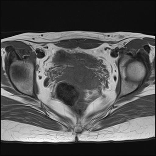 File:Bilateral ovarian endometriomas (Radiopaedia 87085-103347 Axial T1 14).jpg