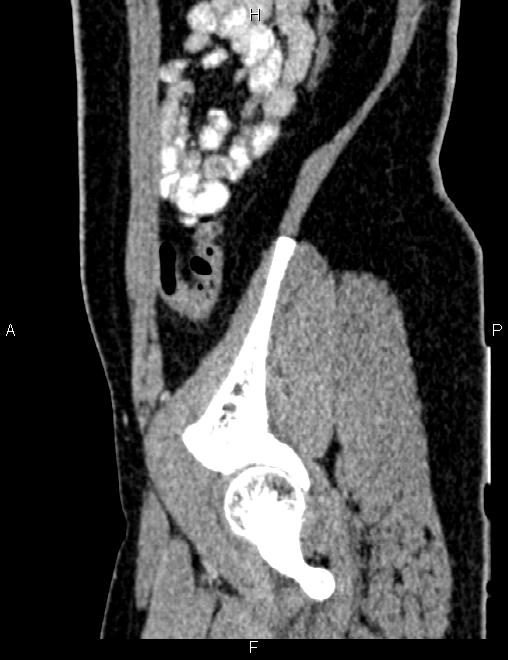 Bilateral ovarian teratoma (Radiopaedia 83131-97503 D 92).jpg
