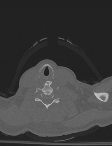 Bilateral perched facet joint (Radiopaedia 63149-71669 Axial bone window 47).jpg