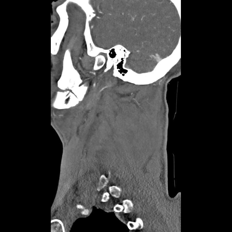 Bilateral perched facets with cord injury (Radiopaedia 45587-49713 B 46).jpg