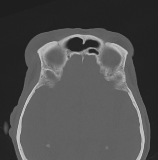 File:Bilateral preseptal periorbital cellulitis (Radiopaedia 43081-46350 Axial bone window 11).png