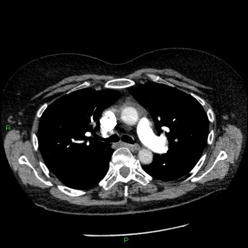 Bilateral pulmonary emboli (Radiopaedia 32700-33669 Axial C+ CTPA 41).jpg
