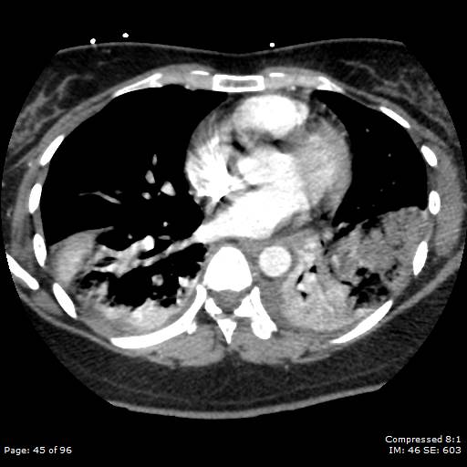 File:Bilateral pulmonary emboli with Hampton hump sign (Radiopaedia 54070-60246 Axial C+ CTPA 42).jpg