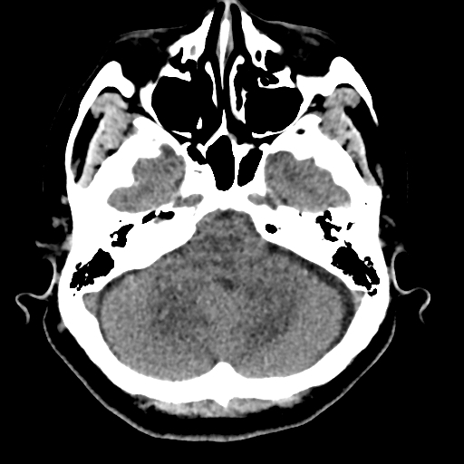 Bilateral subacute subdural hematoma (Radiopaedia 69240-79018 Axial non-contrast 11).jpg