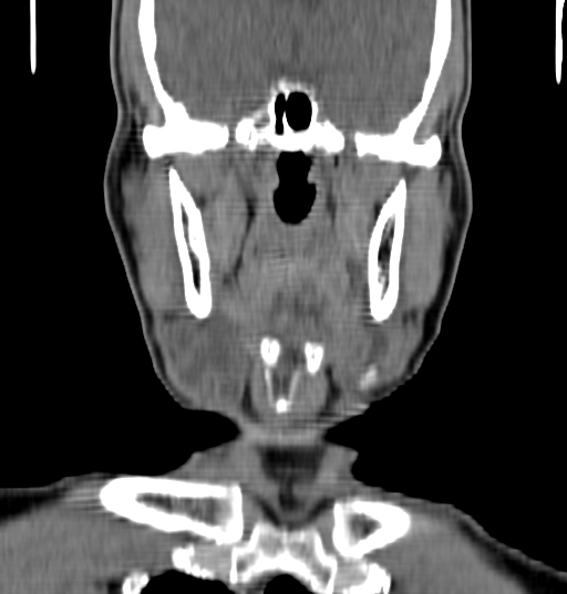File:Bilateral submandibular sialolithiasis with sialadenitis (Radiopaedia 70721-80881 Coronal non-contrast 36).jpg
