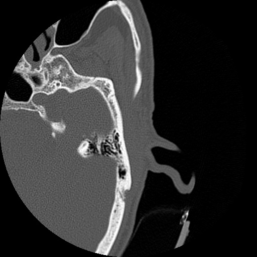 Bilateral temporal bone fractures (Radiopaedia 29482-29970 D 102).jpg