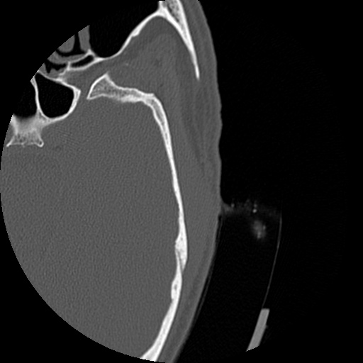 Bilateral temporal bone fractures (Radiopaedia 29482-29970 D 135).jpg