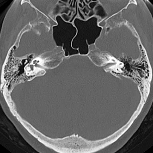 File:Bilateral tympanoplasty (Radiopaedia 16947-16664 Axial bone window 10).jpg