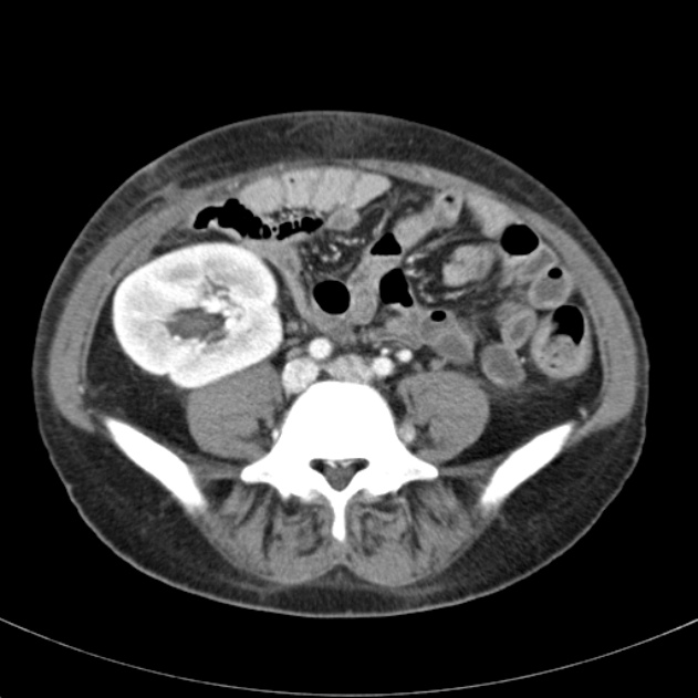 Biliary necrosis - liver transplant (Radiopaedia 21876-21846 B 51).jpg