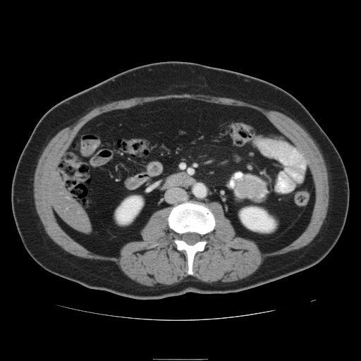 File:Billroth I gastric resection (Radiopaedia 17685-17425 None 32).jpg
