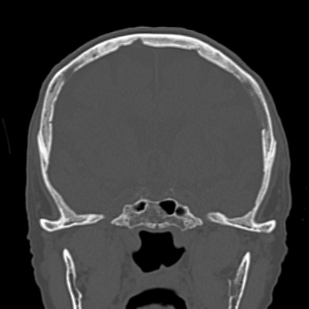 Biparietal osteodystrophy (Radiopaedia 46109-50463 Coronal bone window 48).jpg