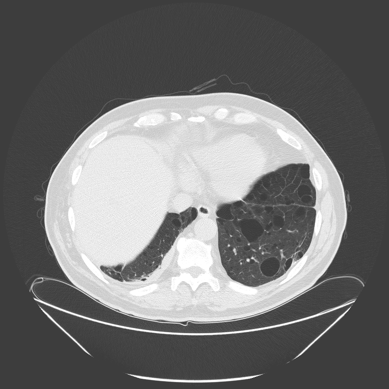 Birt-Hogg-Dubé syndrome (Radiopaedia 52578-58491 Axial lung window 50).jpg