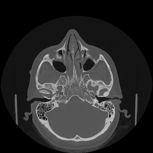 File:Bisphosphonate-related osteonecrosis of the jaw (Radiopaedia 71324-81642 Axial bone window 157).jpg