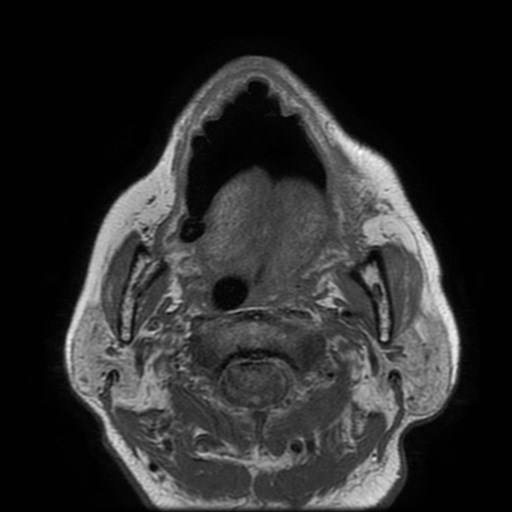 Bisphosphonate-related osteonecrosis of the maxilla (Radiopaedia 51367-57101 Axial T1 16).jpg