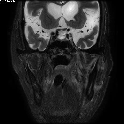 File:Bisphosphonate-related osteonecrosis of the maxilla (Radiopaedia 51367-57101 Coronal T2 fat sat 10).jpg