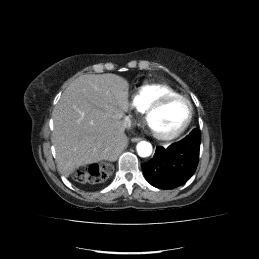 Bladder tumor detected on trauma CT (Radiopaedia 51809-57609 A 71).jpg