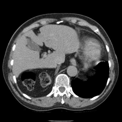 Bladder tumor detected on trauma CT (Radiopaedia 51809-57609 C 29).jpg