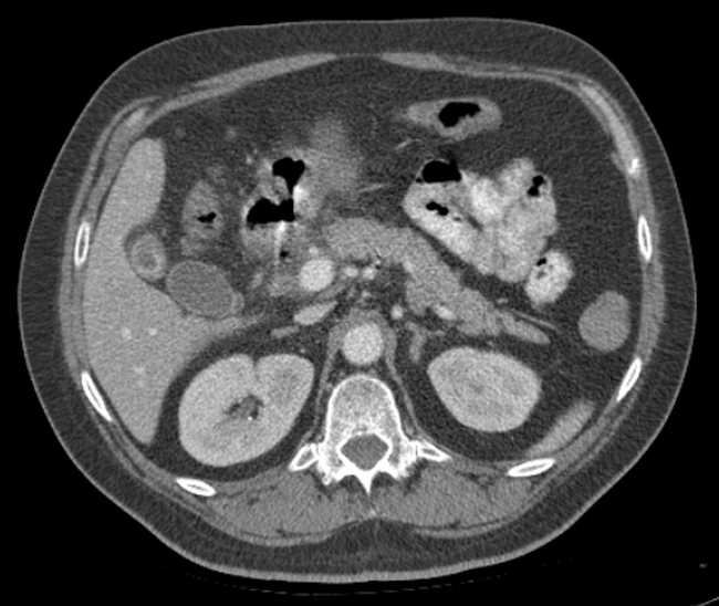 File:Bleeding duodenal ulcer and adenomyomatosis of gallbladder (Radiopaedia 61834-69861 A 36).jpg