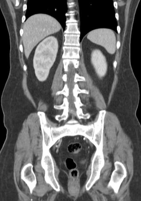 Bleeding duodenal ulcer and adenomyomatosis of gallbladder (Radiopaedia 61834-69861 B 24).jpg