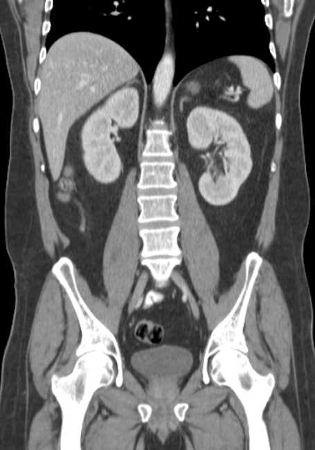 Bleeding duodenal ulcer and adenomyomatosis of gallbladder (Radiopaedia 61834-69861 B 34).jpg