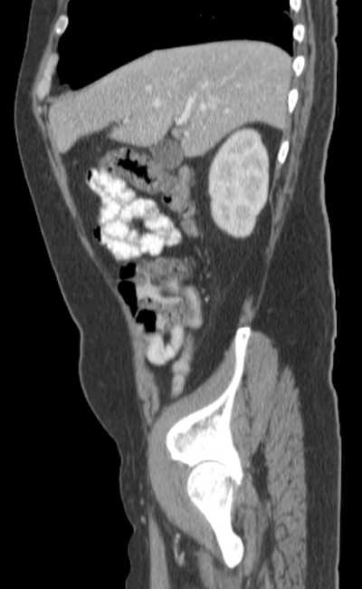 Bleeding duodenal ulcer and adenomyomatosis of gallbladder (Radiopaedia 61834-69861 C 23).jpg
