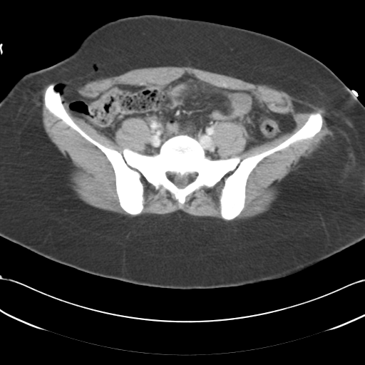 File:Blood in uterovesical and rectovesical pouch in trauma patient (Radiopaedia 34090-35340 C 38).png