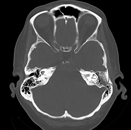 File:Blood on the tentorium simulating hyperdense transverse sinus (Radiopaedia 55521-61991 Axial bone window 11).jpg