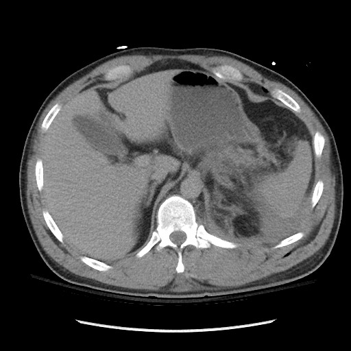 Blunt abdominal trauma with solid organ and musculoskelatal injury with active extravasation (Radiopaedia 68364-77895 Axial C+ delayed 33).jpg