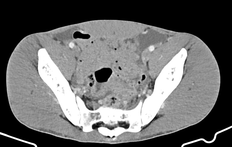 Blunt injury to the small bowel (Radiopaedia 74953-85987 A 161).jpg