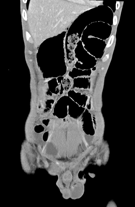 Blunt injury to the small bowel (Radiopaedia 74953-85987 B 22).jpg