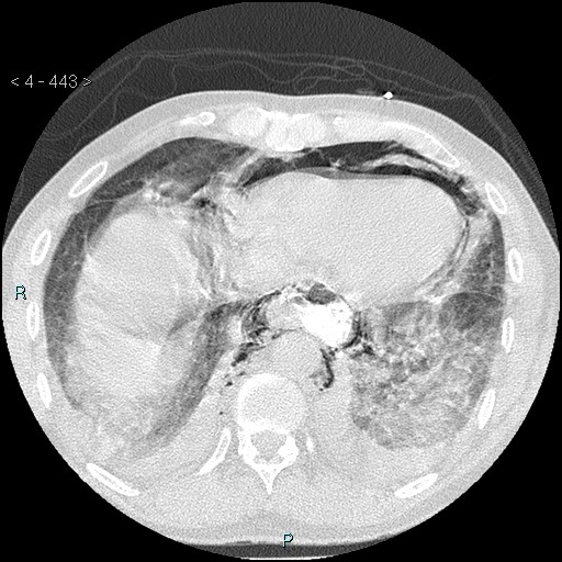 Boerhaave syndrome (Radiopaedia 27683-27897 lung window 75).jpg