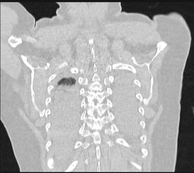 Boerhaave syndrome (Radiopaedia 45644-49799 Coronal lung window 61).jpg