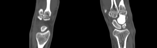Bone islands - carpus (Radiopaedia 63141-71658 Coronal bone window 26).jpg
